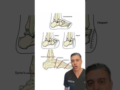 Why is this foot AMPUTATED?!