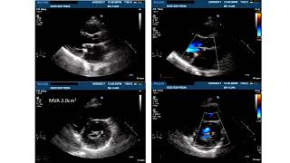 Case studies in rheumatic heart disease – Dr Lisa Simmons