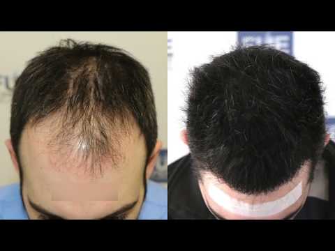 download lagu mp3 mp4 1000 Hair Grafts, download lagu 1000 Hair Grafts gratis, unduh video klip 1000 Hair Grafts