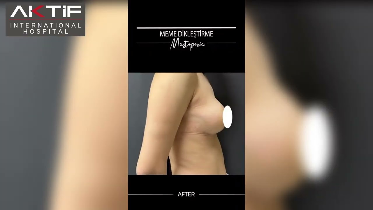 Breast Lift