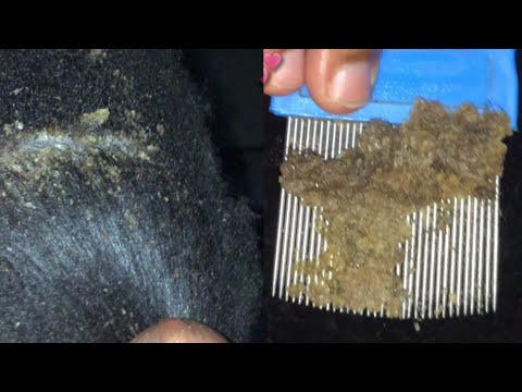 Scalp scratch off // big flakes