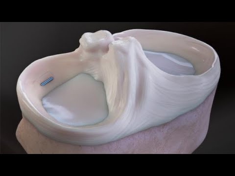 FiberStitch™ All-Inside Meniscus Repair