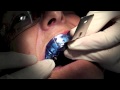 Dentist Training - Single Implant Impression