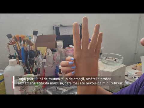 O mână de ajutor: Un tânăr din Bihor rămas fără degete va primi o mănușă bionică