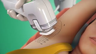 How to treat underarm sweating with miraDry (3D animation)