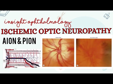 ISCHEMIC OPTIC NEUROPATHY || AION & PION || OPHTHALMOLOGY