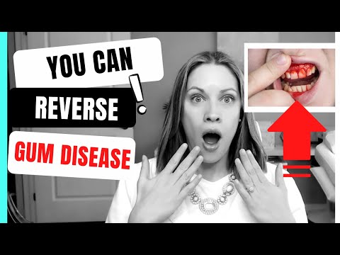 , title : 'How to Reverse Gum Disease at Home'