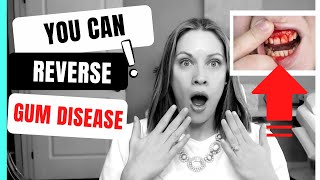 How to Reverse Gum Disease at Home