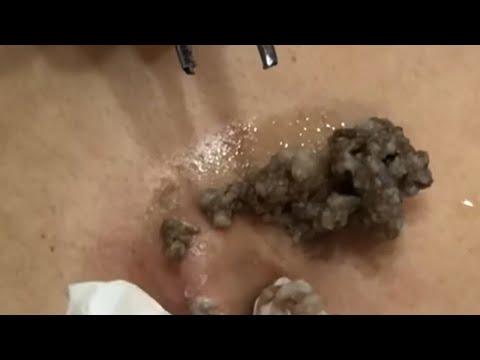 Huge CYST extraction