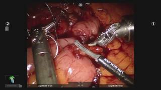 Download Lagu Robotic Right Hemicolectomy with Intracorporeal Anastomosis Using V-Loc™ Thumbnail