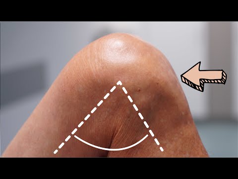 Kniegelenk mit Prothese steift ständig wieder ein