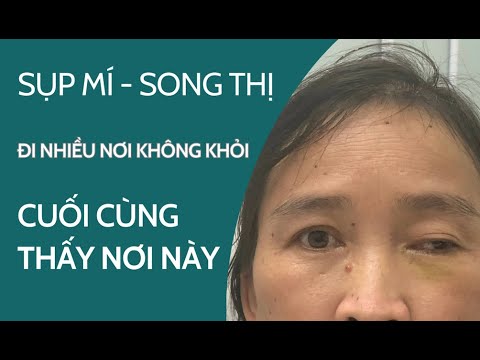 Sụp mí, mắt lác, song thị đi nhiều nơi không khỏi cuối cùng tìm thấy nơi này