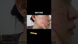 Download lagu Cara Hilangkan Jerawat & Bekas Jerawat #jerawat #bekasjerawat #acne mp3