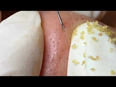 Loan Nguyen Acne Treatment (#141)