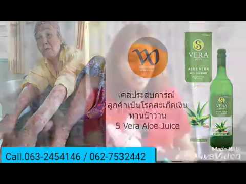 ช่วยโซเดียมไซโอไม่ว่าจะเป็นโรคสะเก็ดเงิน ทั้งสามารถส่งโรคสะเก็ดเงิน