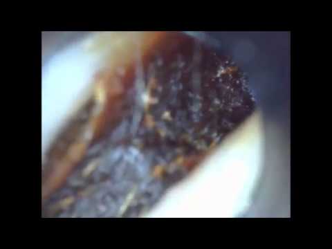 Ear Wax Removal Unbelievable collapsed ear canal