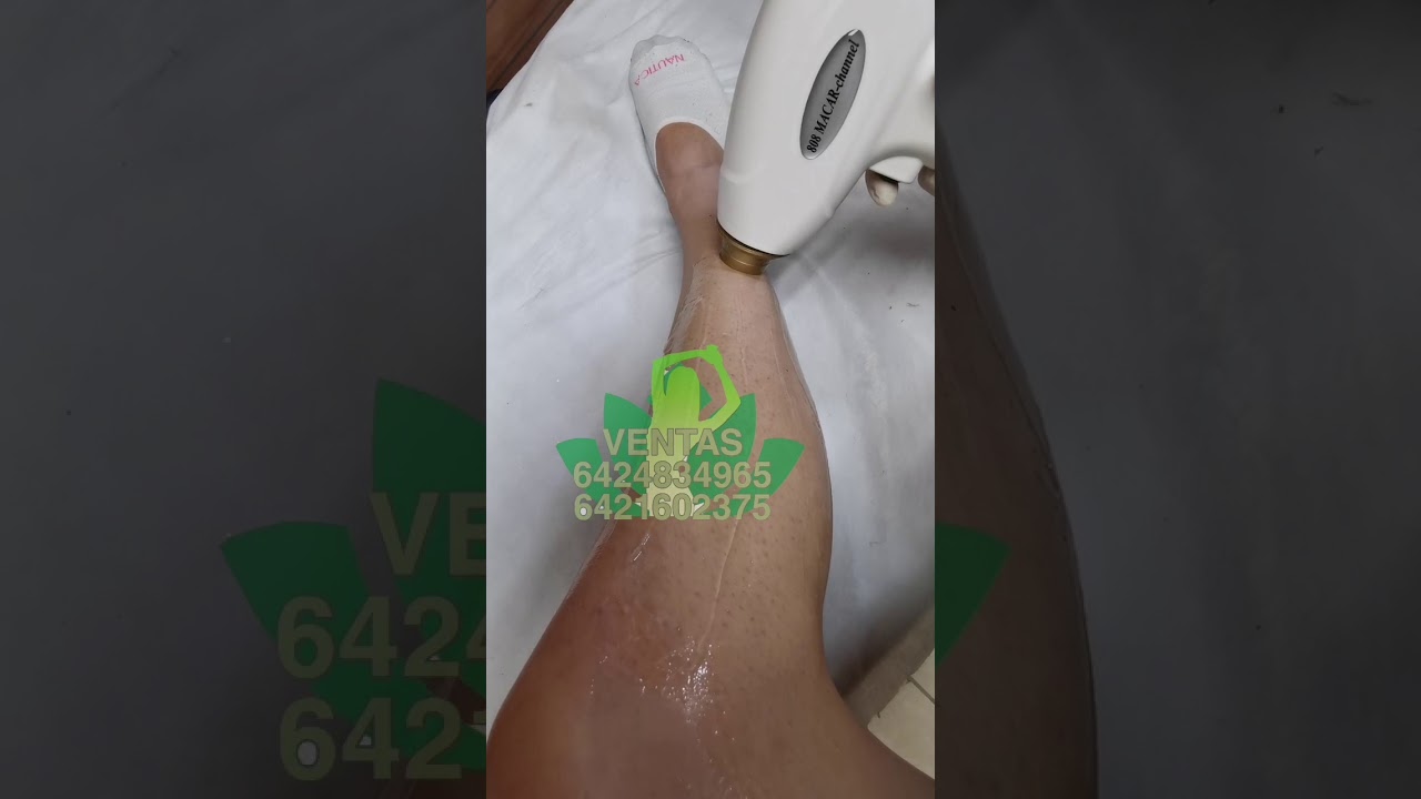 LASER DIODO 808 SEGUNDA PARTE