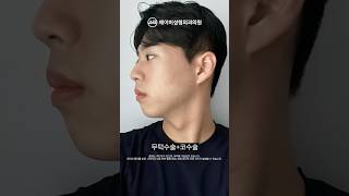 [이중턱근육묶기] 이중턱근육묶기란 무엇인가요??  [21성형외과]