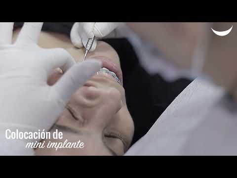 Mini implante ortodoncia Sanadent