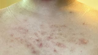 how to get rid of chest acne scars fast tutorial