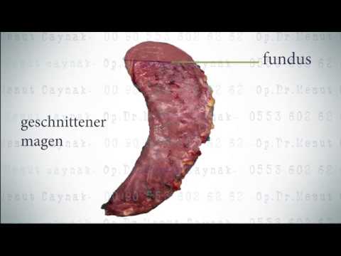 Schlauchmagen ( Sleeve Gastrektomie )
