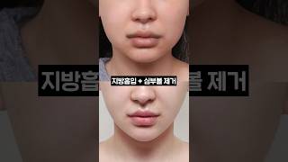 베이저 지방흡입 성형 시술