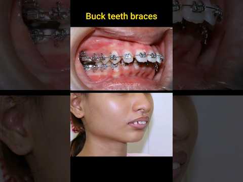 Buck teeth braces process #braces #niengrang #orthodontist #dental