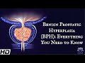 Benign Prostatic Hyperplasia (BPH): Everything You Need To Know