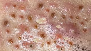 Loan Nguyen Acne Treatment 8m