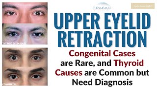 How One can be Born with One Eye Appearing Larger, or Develop it Later in Life