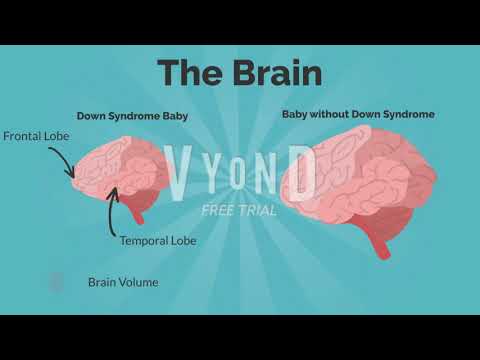 Down Syndrome Unpacked- James Brown (13595955)  Neuroscience UTS