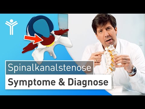 Spinalkanalstenose: Rücken- und Beinschmerzen durch Verengung des Wirbelkanals der LWS