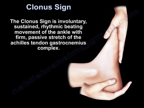 Signe de clonus, sténose spinale cervicale