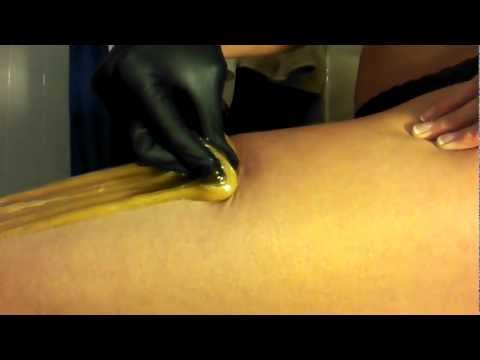 Leg Sugaring Left Thigh