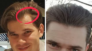 How To Recover Receding Temples And Gaps In Hairline