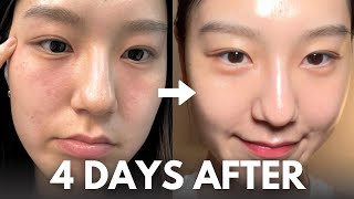 How I repair my skin barrier in 4 days (at home, with affordable skincare routine)