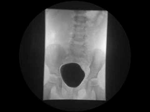 Prostatite scomparso sperma Un intervento chirurgico per liperplasia prostatica benigna