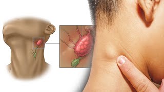 7 Easy Ways To Quickly Unclog Your Lymph Nodes To Reduce Swelling And Flush Out Toxins ⚫healthcare☑️