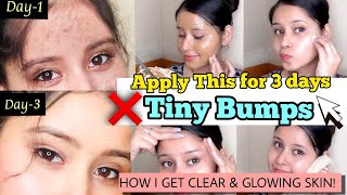 In 3 days💕-Get rid of Tiny Bumps, Pimples & Clogged pores NATURALLY |*Get Glowing bright Skin*