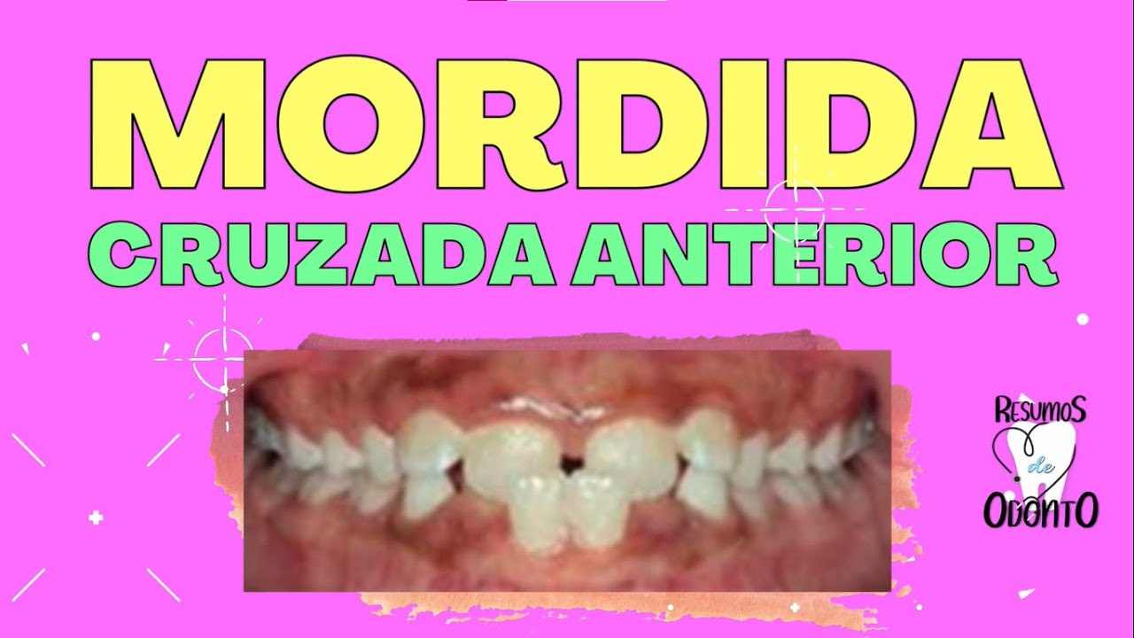 Mordida Cruzada Anterior ! VEM SABER MAIS !!