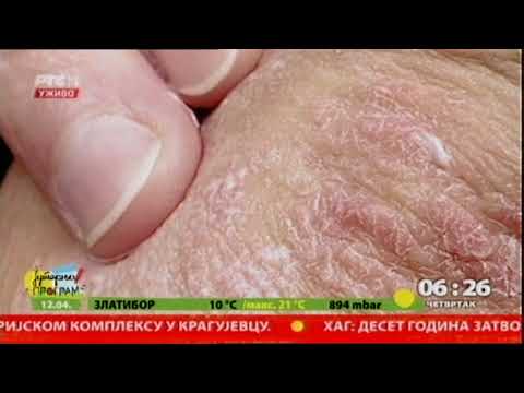 hipertenzija i psorijaza tretmana