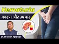 ️पेशाब में खून आने का कारण What Is Hematuria Blood In Urin