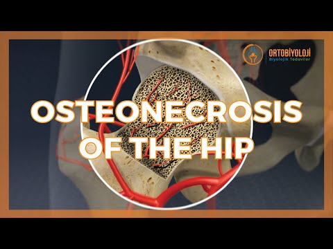 OSTEONECROSIS OF THE HIP & TREATMENTS