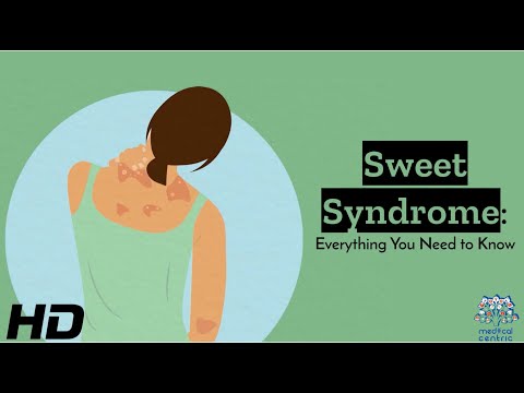 Frozen Shoulder Causes Signs and Symptoms Diagnosis and Treatment