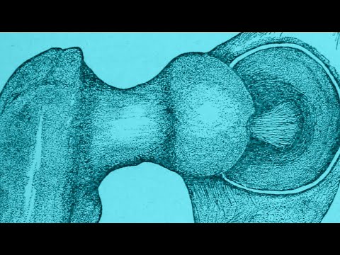 intervertebrális artrosis kezelés