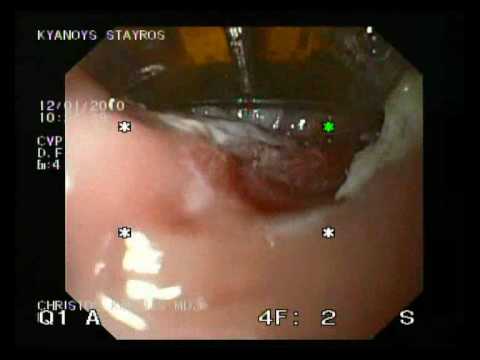 Barrett's Esophagus - Halo 90 Endoscopic Therapy