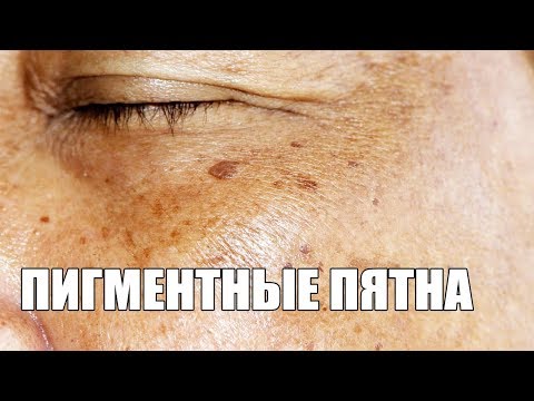Пигментные пятна под глазами что это Избавление от веснушек мазь