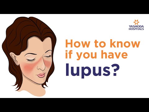 lupus nehéz fogyni