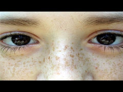 how to get rid of freckles in 5 minutes