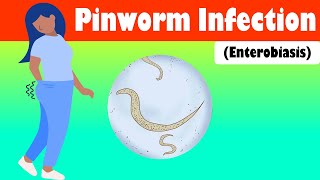 Pinworm Infection (Enterobiasis) - Causes, Signs & Symptoms, Treatment